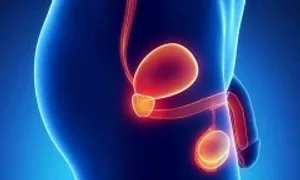 Ung thư tinh hoàn giai đoạn muộn ở tuổi 19